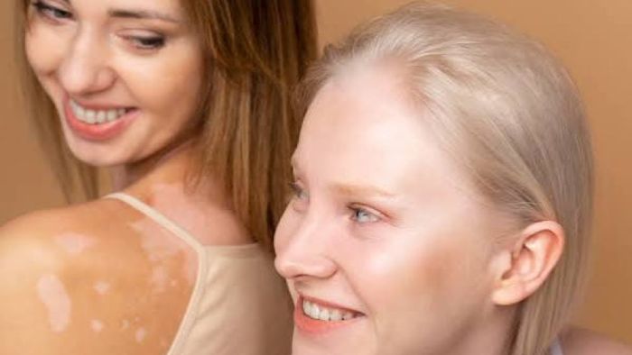 Nişantaşı’nda Excimer Lazer ile Vitiligo Tedavisi